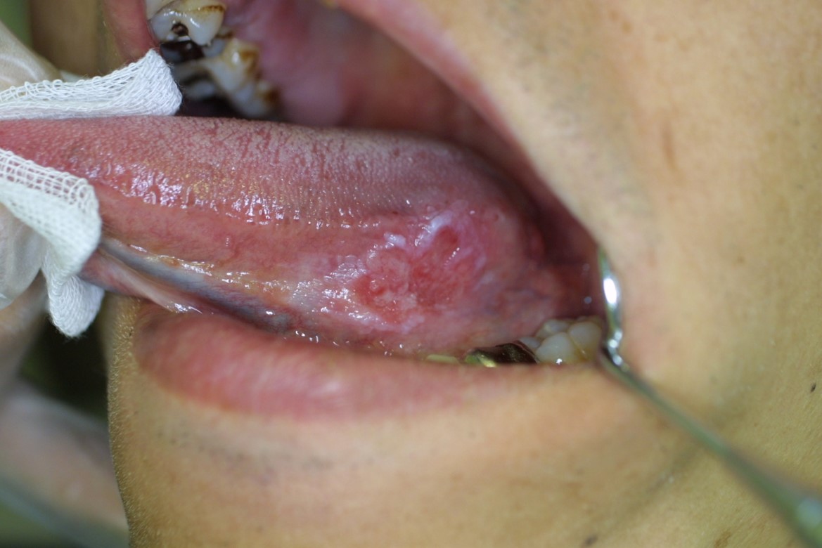 舌、歯肉、頬の粘膜などに赤斑（赤い部分）がある