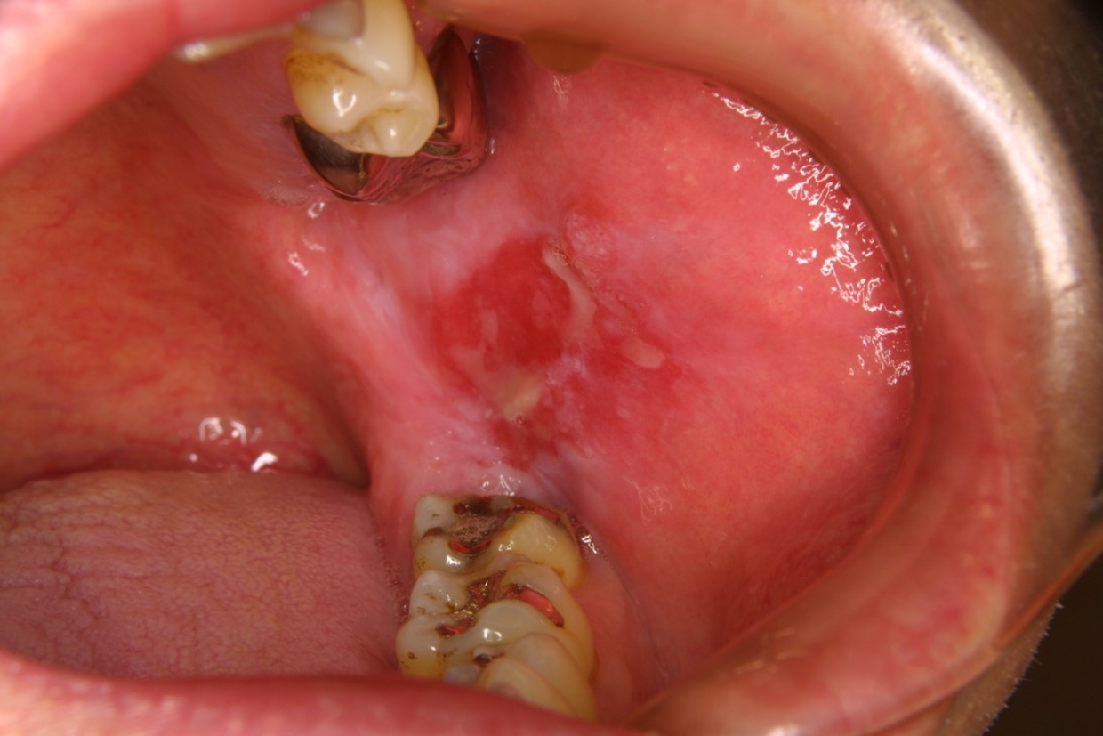 舌、歯肉、頬の粘膜などに赤斑（赤い部分）がある