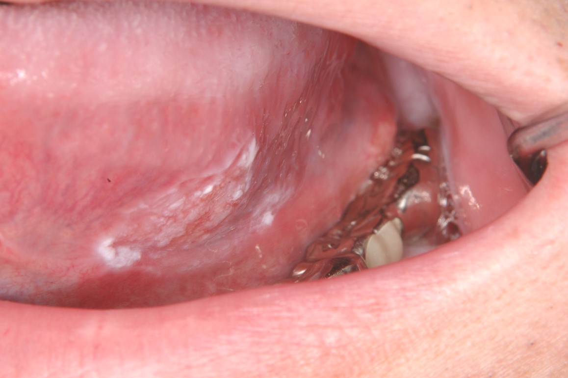 舌、歯肉、頬の粘膜などに白斑（赤い部分が混ざることもある）がある