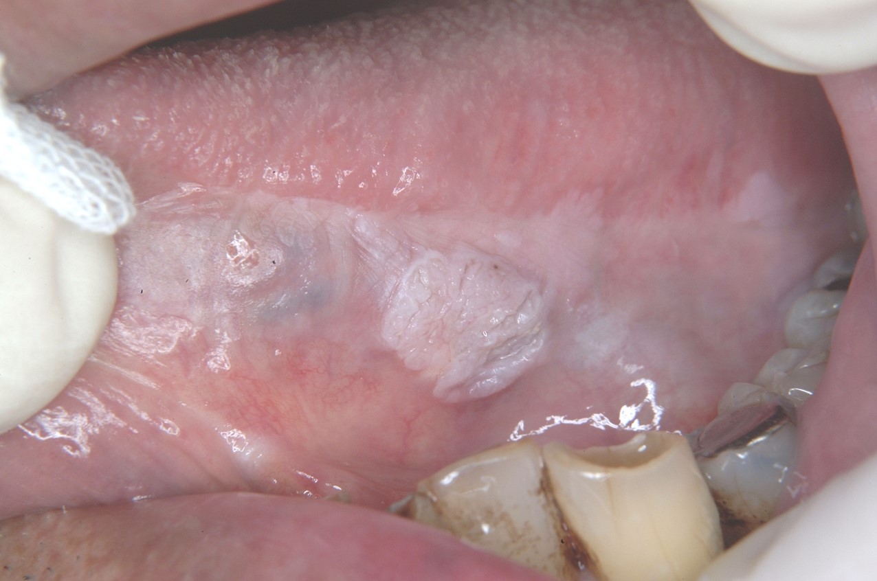 舌、歯肉、頬の粘膜などに白斑（赤い部分が混ざることもある）がある