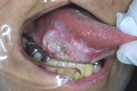 舌や、口の中のその他の部分に、しびれ・麻痺感がある