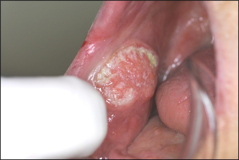 舌や、口の中のその他の部分に、しびれ・麻痺感がある