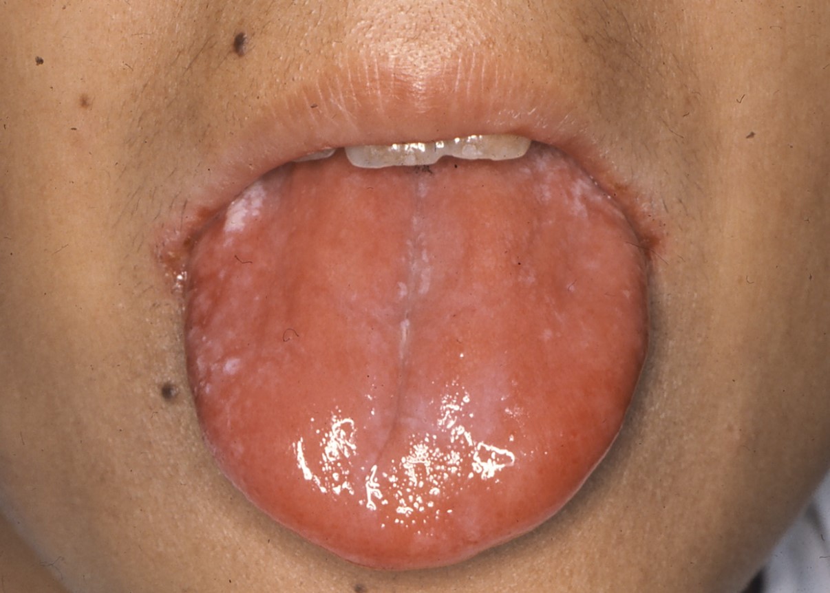 鉄欠乏性貧血（Plummer-Vinson 症候群）による粘膜炎