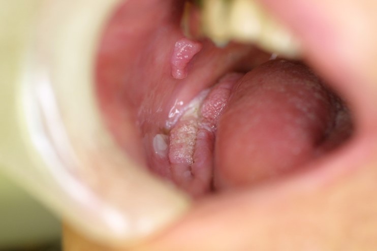 口腔癌の特徴と症状とは 口腔がん Com