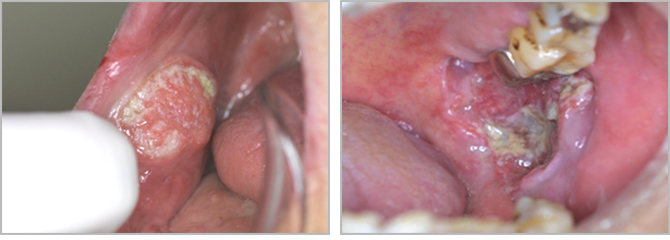 口の中の粘膜にできる癌である頬粘膜癌とは 口腔がん Com